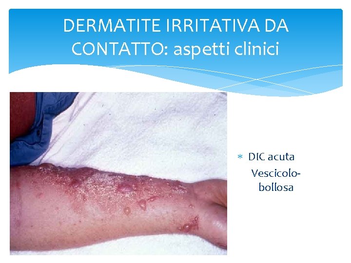 DERMATITE IRRITATIVA DA CONTATTO: aspetti clinici DIC acuta Vescicolobollosa 