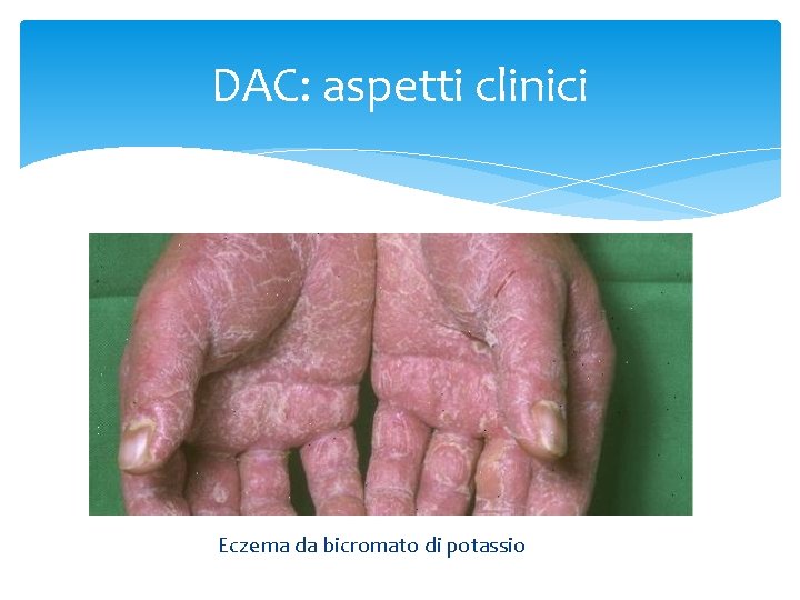 DAC: aspetti clinici Eczema da bicromato di potassio 