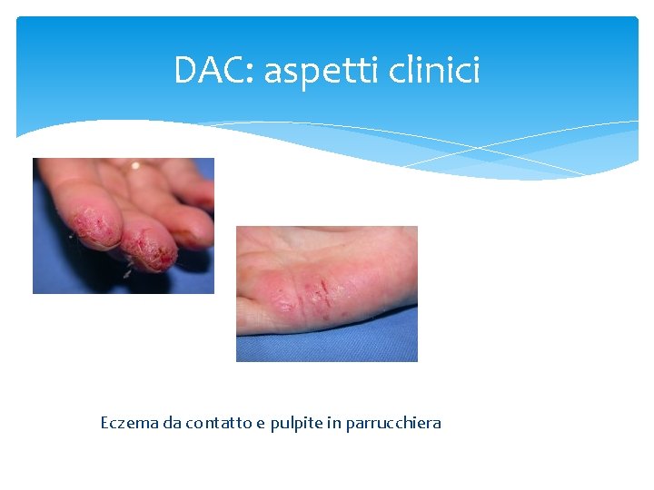 DAC: aspetti clinici Eczema da contatto e pulpite in parrucchiera 