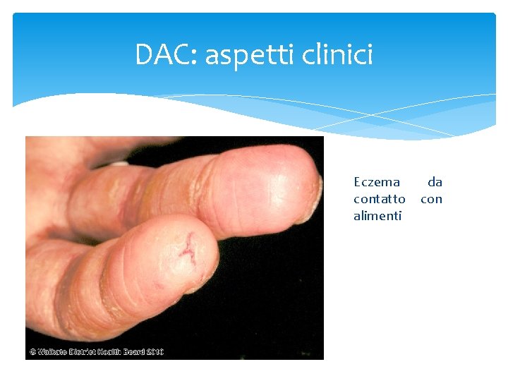 DAC: aspetti clinici Eczema contatto alimenti da con 
