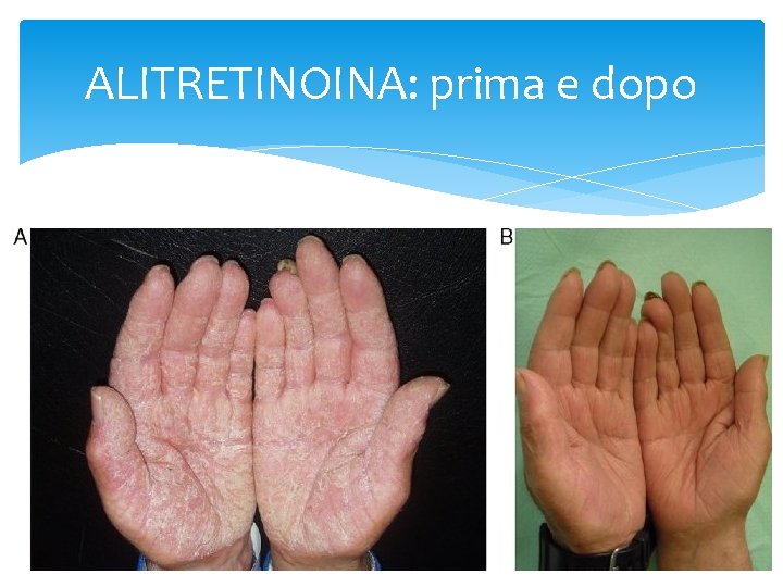 ALITRETINOINA: prima e dopo 