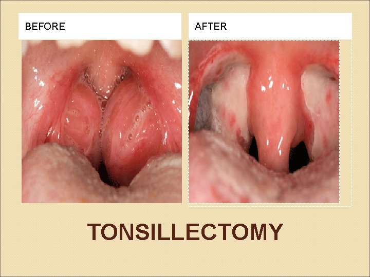 BEFORE AFTER TONSILLECTOMY 