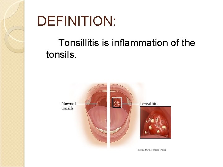 DEFINITION: Tonsillitis is inflammation of the tonsils. 