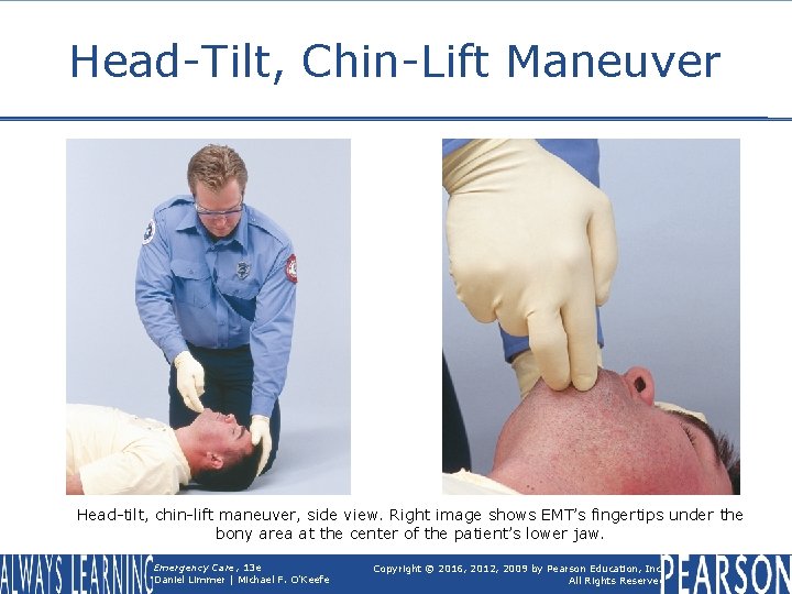 Head-Tilt, Chin-Lift Maneuver Head-tilt, chin-lift maneuver, side view. Right image shows EMT’s fingertips under