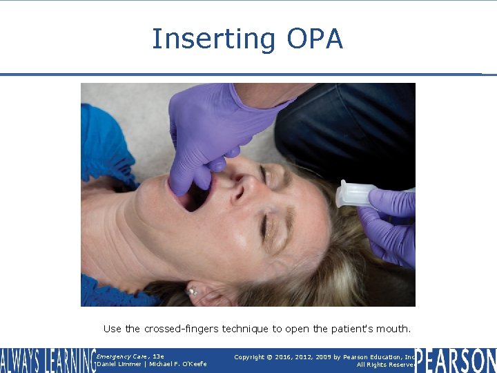 Inserting OPA Use the crossed-fingers technique to open the patient's mouth. Emergency Care, 13