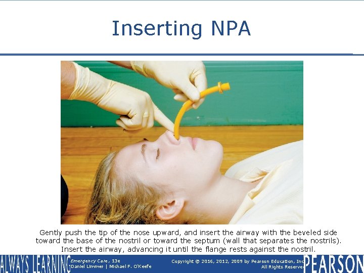 Inserting NPA Gently push the tip of the nose upward, and insert the airway