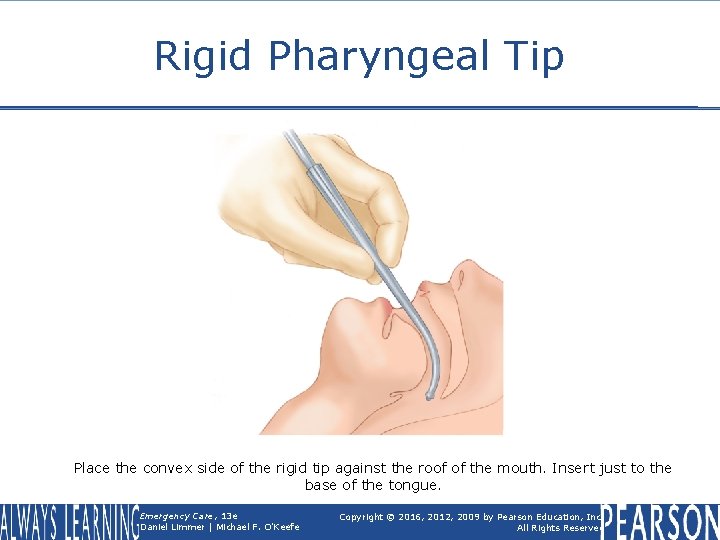 Rigid Pharyngeal Tip Place the convex side of the rigid tip against the roof