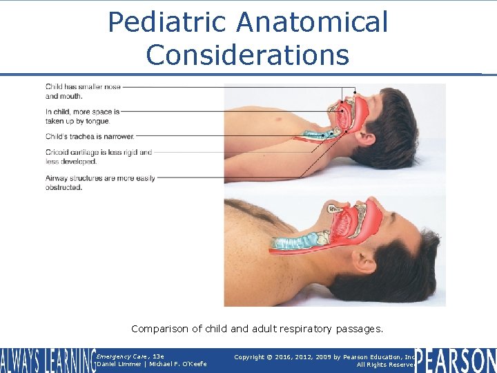 Pediatric Anatomical Considerations Comparison of child and adult respiratory passages. Emergency Care, 13 e