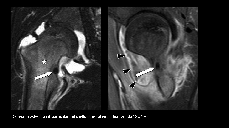 Osteoma osteoide intraarticular del cuello femoral en un hombre de 18 años. 