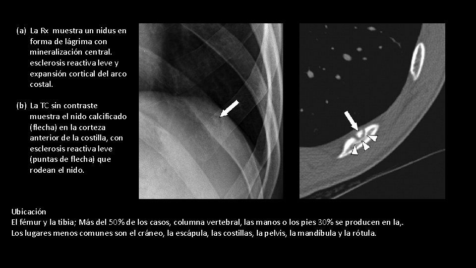 (a) La Rx muestra un nidus en forma de lágrima con mineralización central. esclerosis