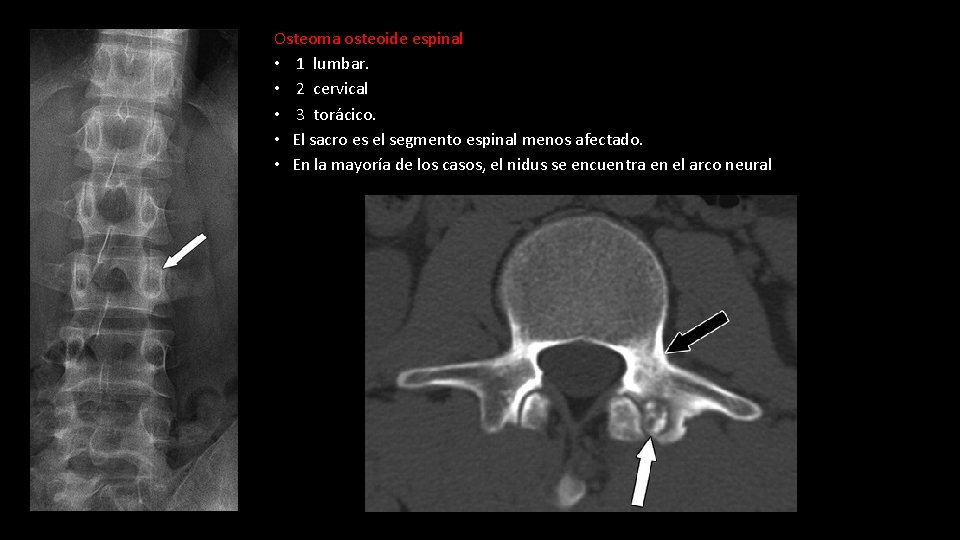 Osteoma osteoide espinal • 1 lumbar. • 2 cervical • 3 torácico. • El