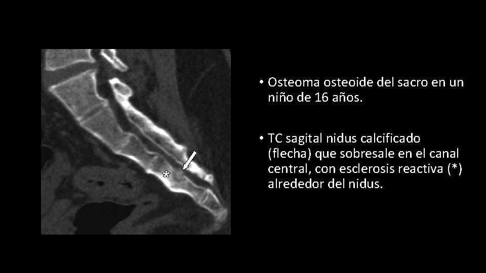  • Osteoma osteoide del sacro en un niño de 16 años. • TC