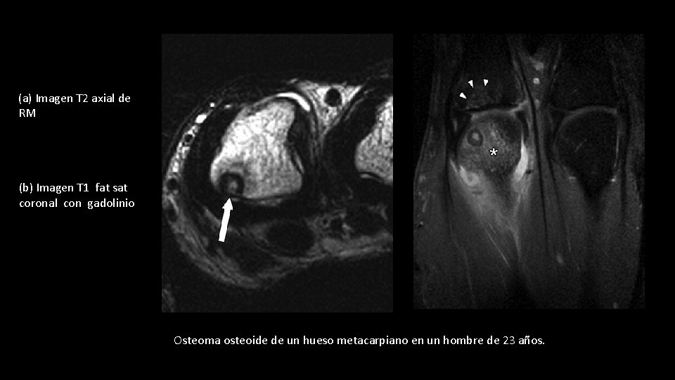 (a) Imagen T 2 axial de RM (b) Imagen T 1 fat sat coronal