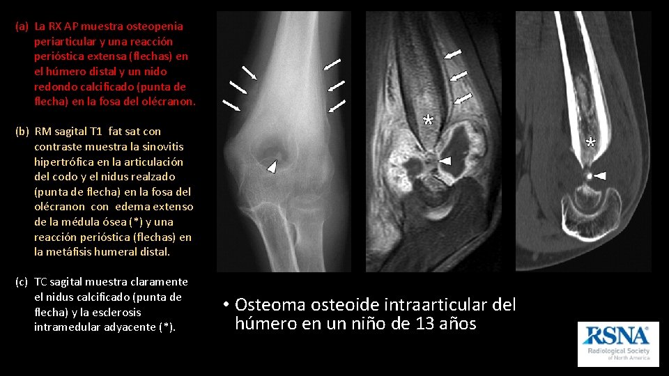 (a) La RX AP muestra osteopenia periarticular y una reacción perióstica extensa (flechas) en