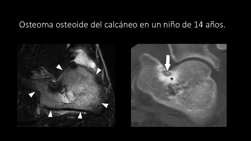 Osteoma osteoide del calcáneo en un niño de 14 años. 