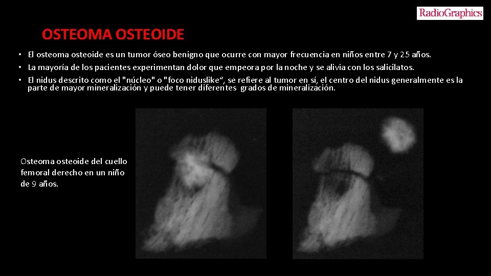 OSTEOMA OSTEOIDE • El osteoma osteoide es un tumor óseo benigno que ocurre con
