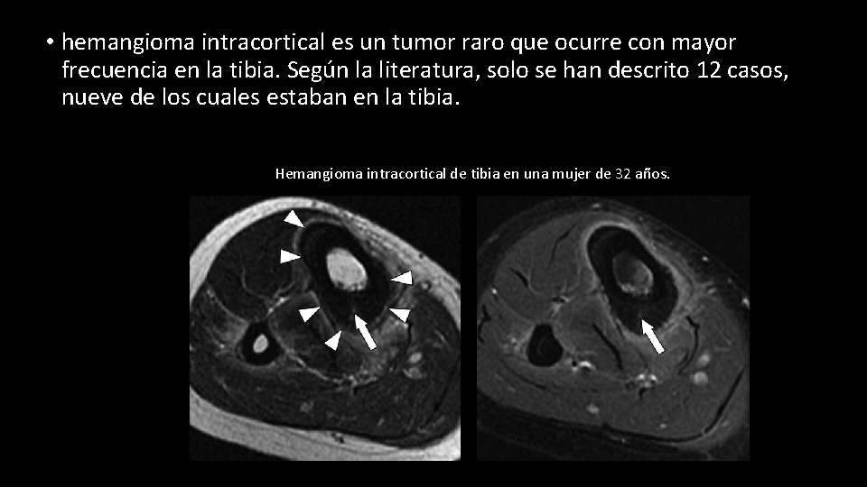  • hemangioma intracortical es un tumor raro que ocurre con mayor frecuencia en