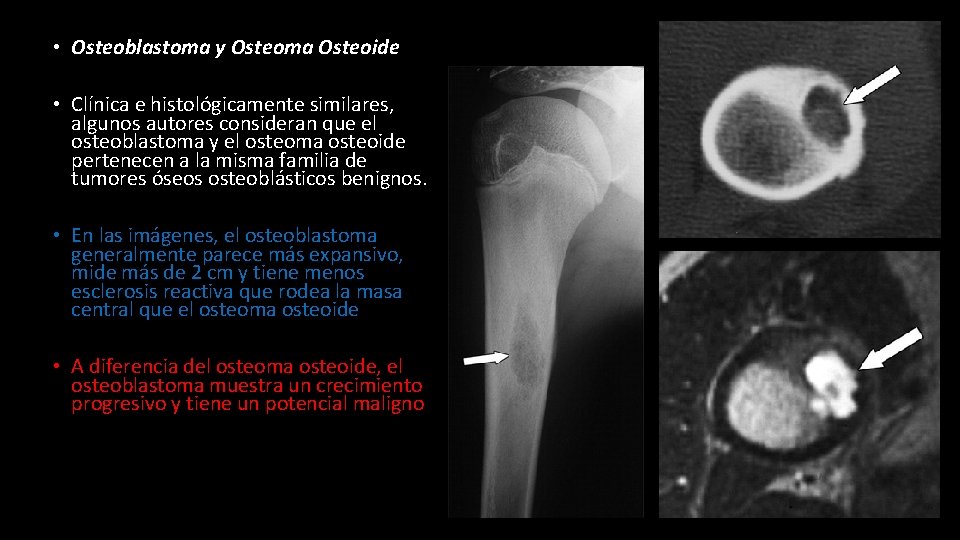  • Osteoblastoma y Osteoma Osteoide • Clínica e histológicamente similares, algunos autores consideran