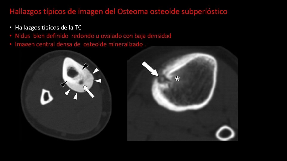 Hallazgos típicos de imagen del Osteoma osteoide subperióstico • Hallazgos típicos de la TC