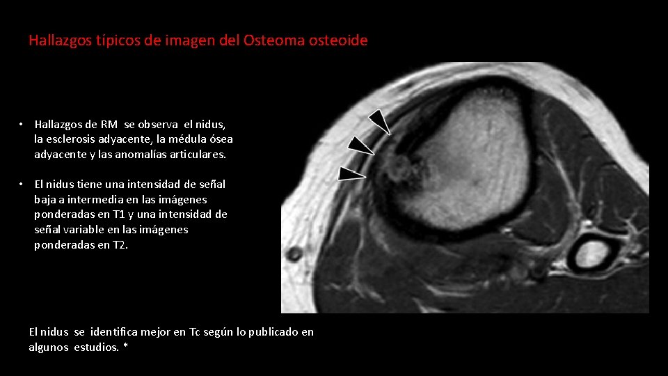 Hallazgos típicos de imagen del Osteoma osteoide • Hallazgos de RM se observa el
