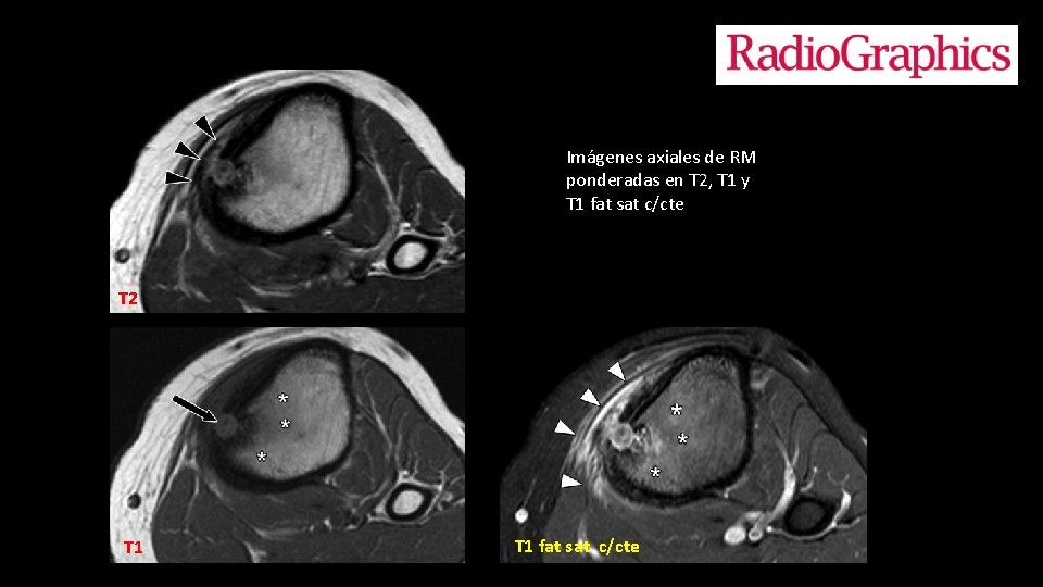 Imágenes axiales de RM ponderadas en T 2, T 1 y T 1 fat