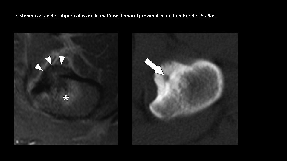 Osteoma osteoide subperióstico de la metáfisis femoral proximal en un hombre de 25 años.