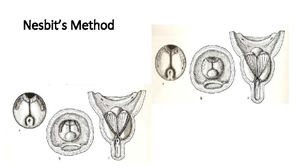 Nesbit’s Method 