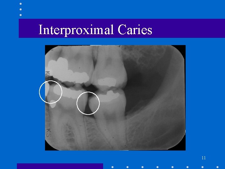 Interproximal Caries 11 