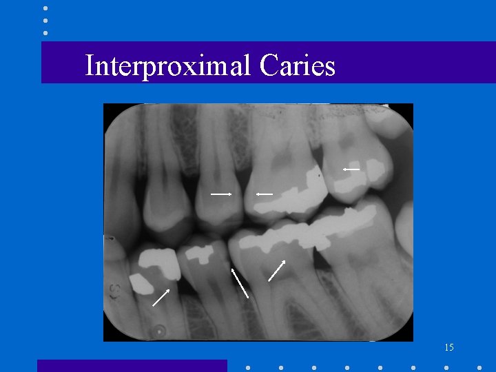 Interproximal Caries 15 