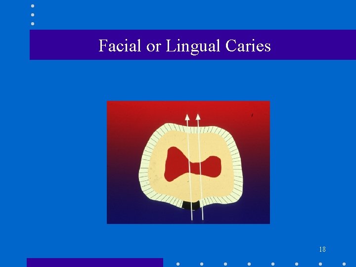Facial or Lingual Caries 18 