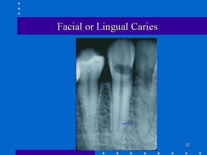 Facial or Lingual Caries 20 