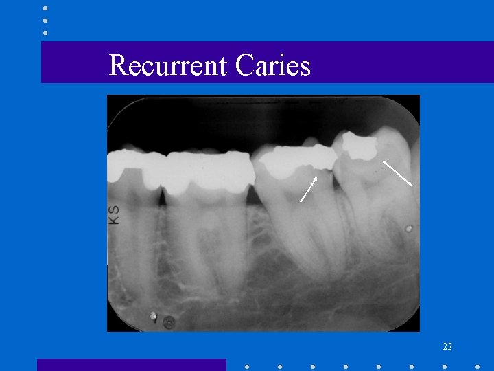 Recurrent Caries 22 