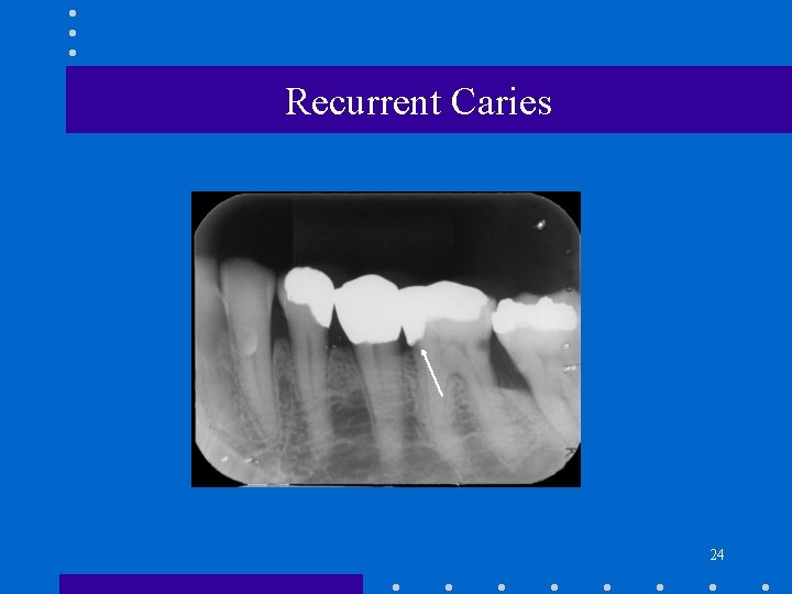 Recurrent Caries 24 