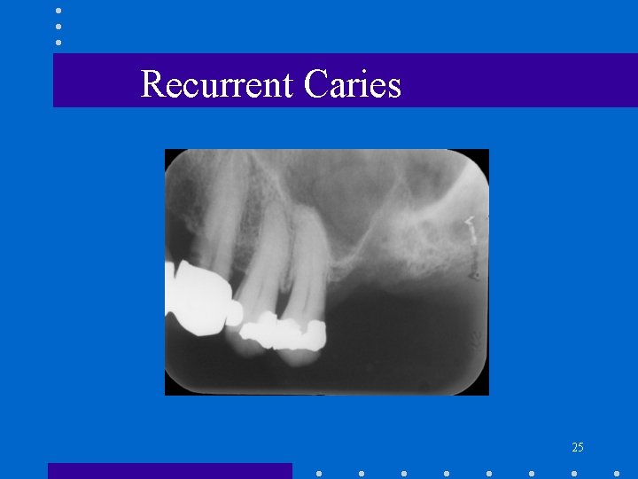 Recurrent Caries 25 