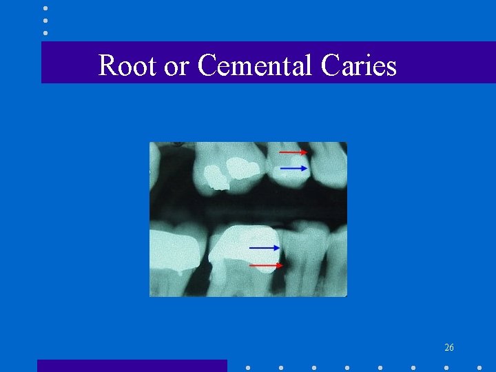 Root or Cemental Caries 26 