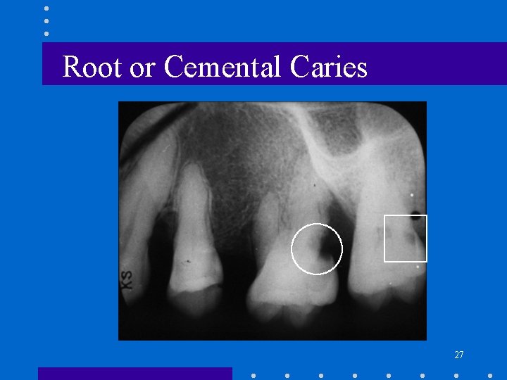 Root or Cemental Caries 27 