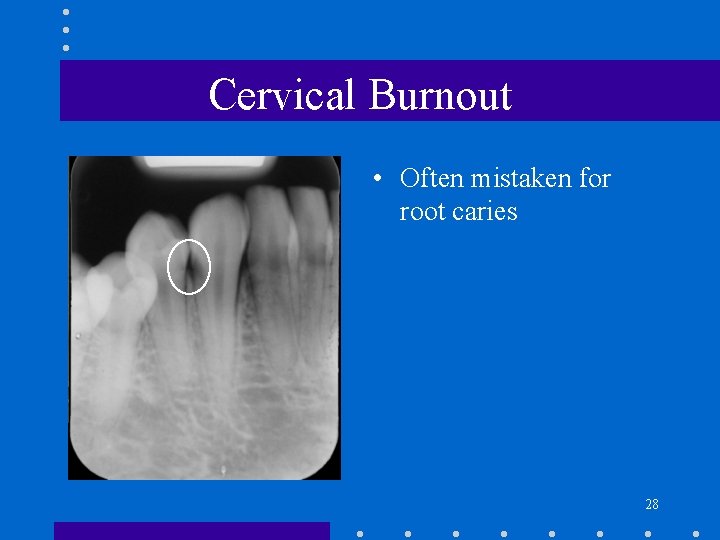 Cervical Burnout • Often mistaken for root caries 28 