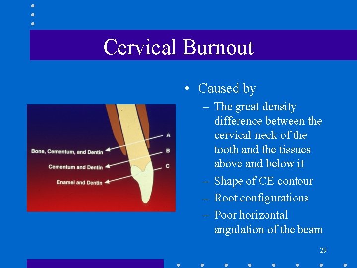 Cervical Burnout • Caused by – The great density difference between the cervical neck