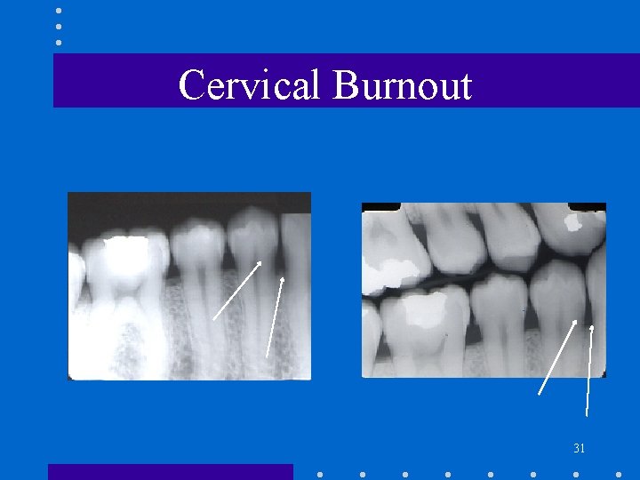Cervical Burnout 31 