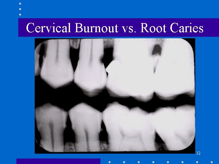 Cervical Burnout vs. Root Caries 32 