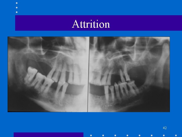 Attrition 42 