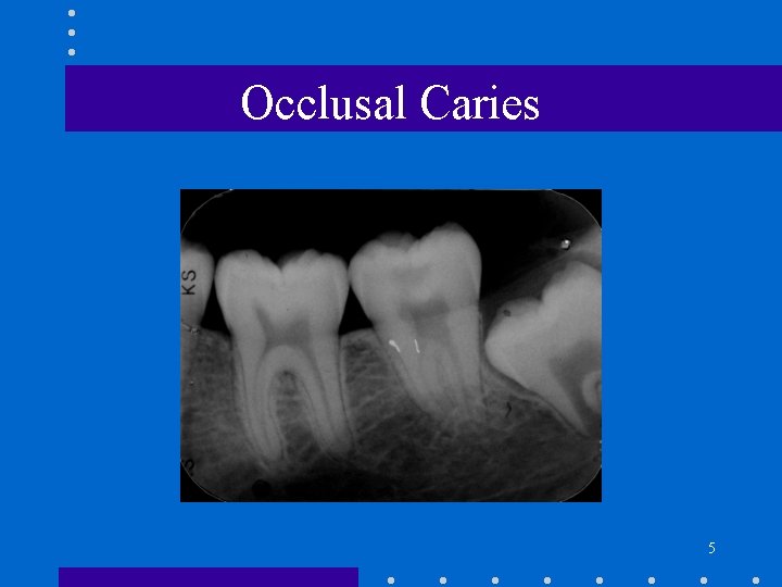 Occlusal Caries 5 