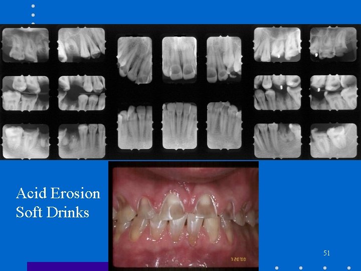 Acid Erosion Soft Drinks 51 