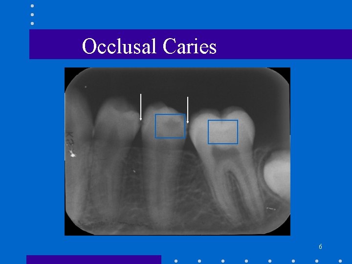Occlusal Caries 6 