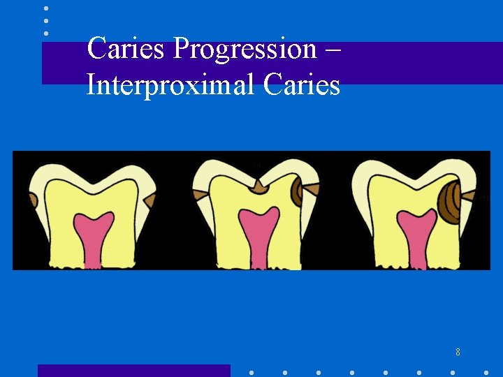 Caries Progression – Interproximal Caries 8 