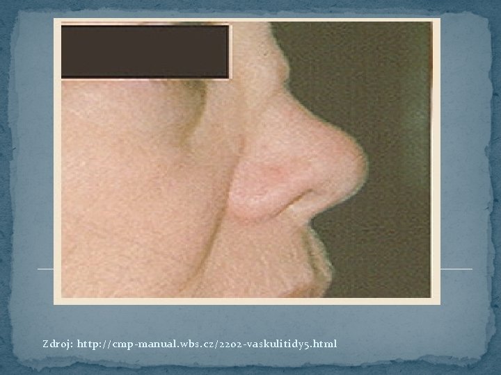 Zdroj: http: //cmp-manual. wbs. cz/2202 -vaskulitidy 5. html 