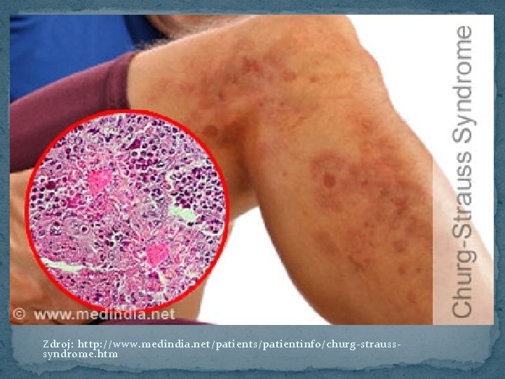 Zdroj: http: //www. medindia. net/patients/patientinfo/churg-strausssyndrome. htm 