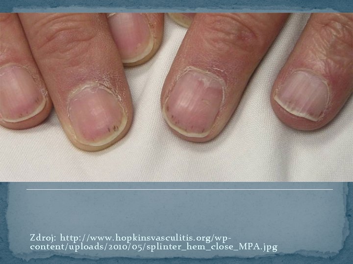 Zdroj: http: //www. hopkinsvasculitis. org/wpcontent/uploads/2010/05/splinter_hem_close_MPA. jpg 