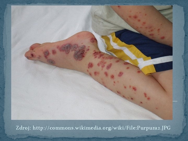 Zdroj: http: //commons. wikimedia. org/wiki/File: Purpura 2. JPG 