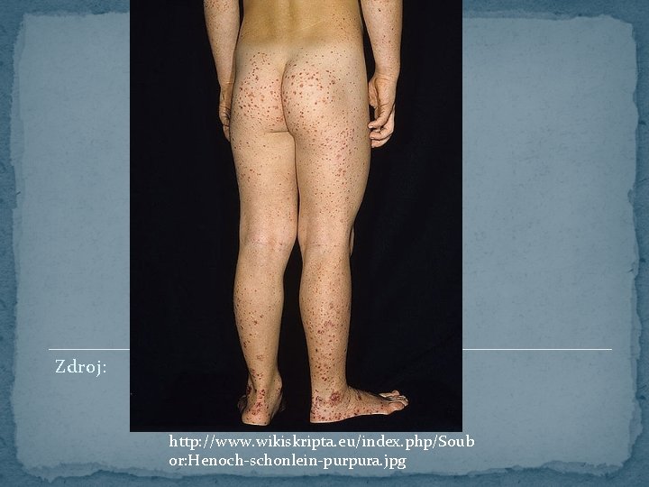Zdroj: http: //www. wikiskripta. eu/index. php/Soub or: Henoch-schonlein-purpura. jpg 